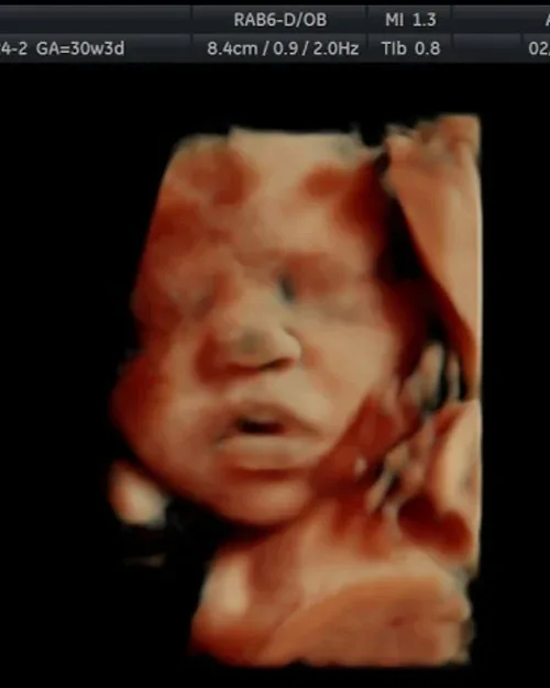 3D ultrasound of a baby with hand near face