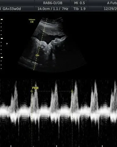 Heartbeat Bear Session ultrasound at A Future Look in Jackson, Ohio